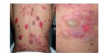 pemphigus-vulgaris-10-638