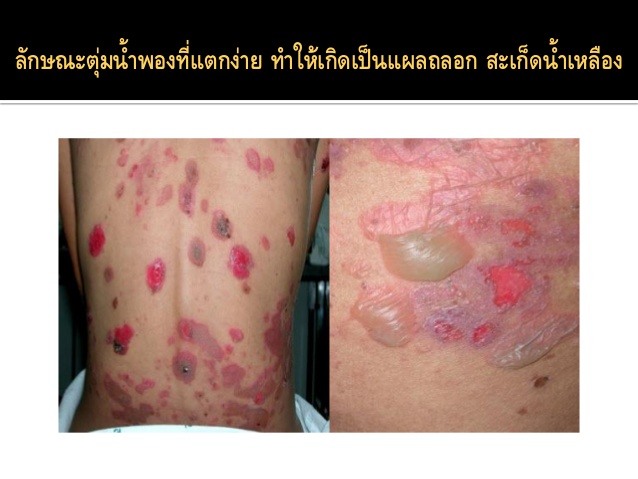 pemphigus-vulgaris-10-638